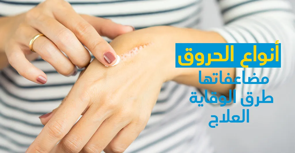 أنواع الحروق و مضاعفاتها و طرق الوقاية و العلاج